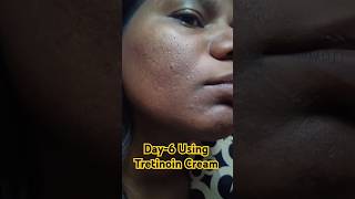 Day6 using Tretinoin Cream 0025 viralvideo skincare tretinoin shorts [upl. by Ttesil]