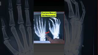 Fracture 5th Metacarpal Bone⚡️ Xray Hand xray fracture bones [upl. by Nomrej]