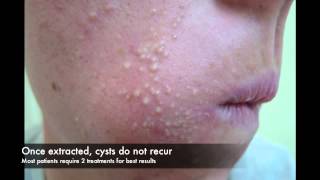 Acne cyst laser treatment [upl. by Adnema446]