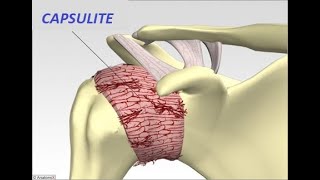 Capsulite Adesiva ou Síndrome do Ombro Congelado  Causa oculta de dor intensa e rigidez do Ombro [upl. by Otreblon]