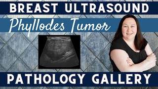 Breast Ultrasound Pathology Gallery  Phyllodes Tumor  Sonography Minutes [upl. by Dann]