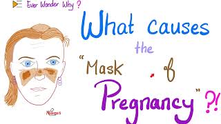 Whats the reason behind “The Mask 😷 of Pregnancy 🤰” 😶‍🌫️😊🤷‍♀️ [upl. by Jessamine589]