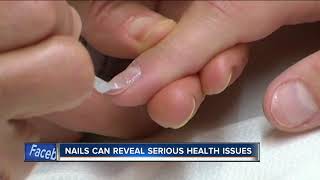 Doctors warn to check your nails for dangerous skin cancer [upl. by Halil97]