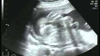 24 weeks pregnant ultrasound sonogram [upl. by Ahselak]