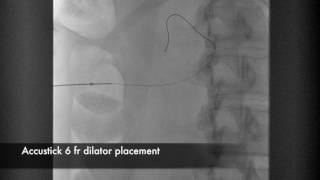 Percutaneous Nephrostomy [upl. by Nivre]