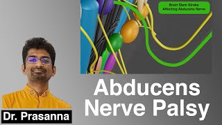 Abducens Nerve Palsy [upl. by Gearhart614]