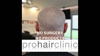 hairtransplant scar farewell No surgery no products involved shorts scalpmicropigmentation [upl. by Mariand]