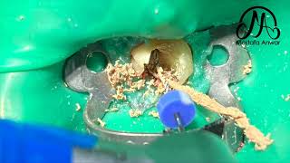 How To Remove GuttaPercha Easily During Root Canal Retreatment Cases  Easy GuttaPercha Removal [upl. by Anisirhc]