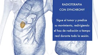 Radioterapia con Synchrony y cáncer de pulmón [upl. by Peirce]