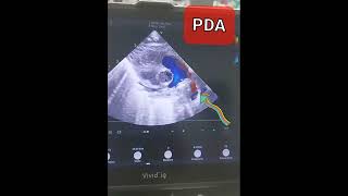 Neonatal Echocardiogram  Patent Ductus Arteriosus PDA ShortAxis Echo with Doppler Flow [upl. by Merriott]