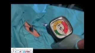 Cricothyroidotomy Ravussin Cannula [upl. by Aratehs]