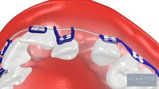 Oque é Ortodontia Como funciona um Aparelho Ortodôntico ortodontia invisalign clinicajin [upl. by Ajet]