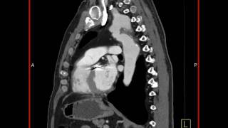 4D Imaging of the Aortic Valve Repaired coarctation of the aorta 2 of 3 [upl. by Ahsinned]