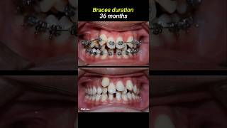 Braces for crowded teeth braces orthodontist dentistry dentist [upl. by Nnaecyoj]