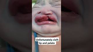 Unfortunately newborn babygirl with cleft lip and palate 🍼🤱  babygirl breastfeeding cutebaby [upl. by Hepsiba]