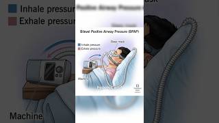 CPAP vs BiPAP [upl. by Norramic]