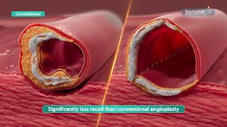 Serranator PTA Serration Balloon Catheter  Mechanism of Action [upl. by Benis]