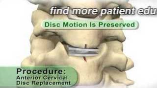 Anterior Cervical Artificial Disc Replacement [upl. by Trinity]