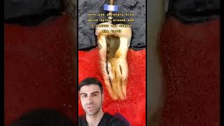 Root Canals Explained [upl. by Ylrad]