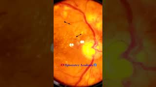 Diabetic retinopathy  Hemorrhages  cotton wool spots  Hard exudates  Fundus  Short Video 134 [upl. by Takeshi494]