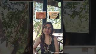 Hyperpigmentation around your mouth shorts [upl. by Damal]