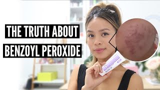 Clear Acne With Benzoyl Peroxide Pros and Cons [upl. by Dolan]