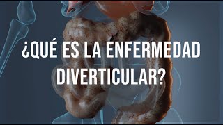 Enfermedad Diverticular Síntomas Diagnóstico y Tratamiento con el Dr Hugo Paredes [upl. by Drandell365]