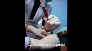 Tutorial aspiration of liver abscess 1 [upl. by Auburta]