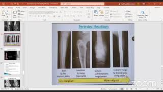 Osteosarcoma amp Ewing Sarcoma [upl. by Nospmas]