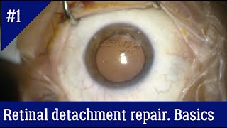 The general principles of vitrectomy for retinal detachment repair [upl. by Hsiekal]