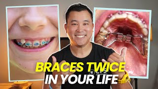 Do You Actually Need Early Braces Early Interceptive Orthodontic Phase I Treatment Explained [upl. by Mello]