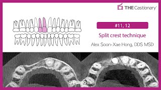 11 12 Split crest technique [upl. by Aiuhsoj365]