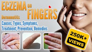 Eczema on Fingers Causes Types Symptoms Treatment and Remedies  Small Blisters and How To Treat [upl. by Arabeila]