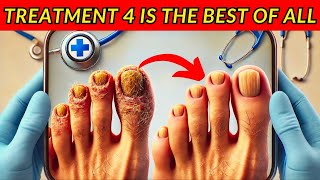 How to Get Rid of Nail Fungus Fast Top 6 Effective Treatments [upl. by Hessney686]