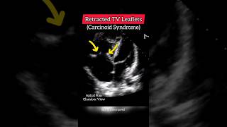 Retracted Leaflets of Tricuspid Valve seen in a patient of Carcinoid Syndrome heart echo [upl. by Atiuqin]