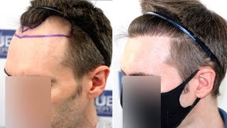 FUE Hair Transplant 1500 Grafts NW III A By Dr Juan Couto  FUEXPERT CLINIC Madrid Spain [upl. by Ashien]