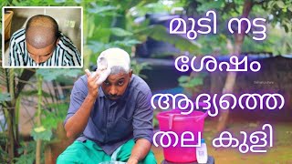 First Head Wash After hair transplantation  എന്റെ തല കുളി  safvan pullara [upl. by Tenom]