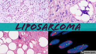 Liposarcoma 101 Everything a Pathologist Needs to Know [upl. by Sirovaj195]