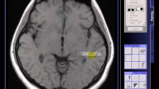 Brain MRI On case Widening cavum septum pelucidum [upl. by Anegroeg]