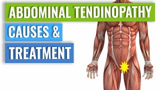 Abdominal Tendinopathy  Causes and Treatment Including Exercises [upl. by Iemaj279]