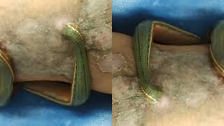 Learn Easy tricks for Ayurveda  Leech therapy [upl. by Ttenneb]