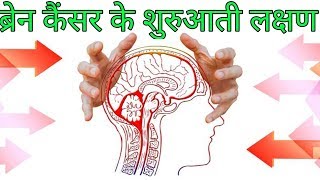 ब्रैन कैंसर के लक्षणbrain cancer ke lakshanbrain cancer symptoms hindi [upl. by Nilre]