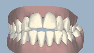 Invisalign ClincheckIncreased overlap of teethwmv [upl. by Ailasor]