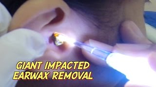 Giant Impacted Earwax Removal [upl. by Aidua999]