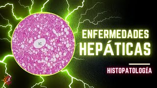 Enfermedades Hepáticas  HISTOPALOGÍA [upl. by Langille127]