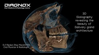 CBCT Sialography of submandibular gland 3D Imaging [upl. by Pincince]