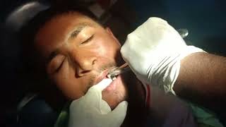 first molar extraction teeth by Rajesh mandal dental hygienist [upl. by Bunnie]