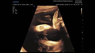 Arthrogryposis Multiplex congenita fetal ultrasound [upl. by Nert448]