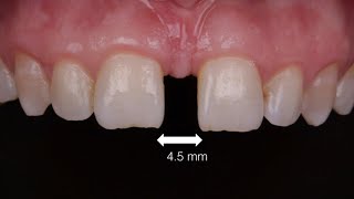 The easiest way to close the diastema using proximal unica matrix with composite bonding [upl. by Togram983]