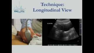 First Trimester Pregnancy Ultrasound [upl. by Anelrad]